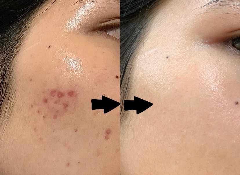 Trị Mụn